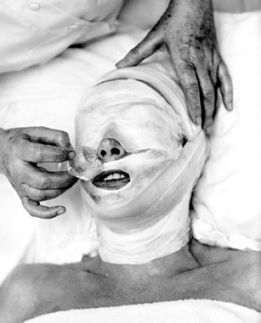 1959-ice-treatment