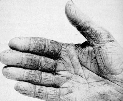 1964 Hand fissures