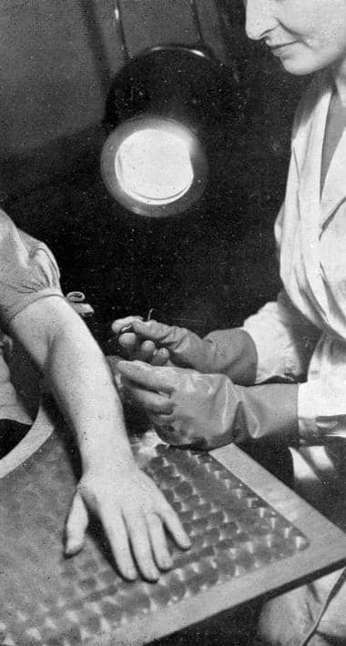 1934 Using thermolysis to remove forearm hair